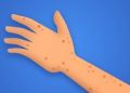 5 Monkeypox Myths We Need To Stop Believing