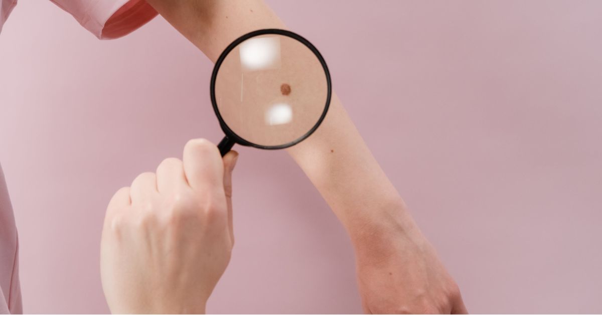 How Does Skin Cancer Appear?
