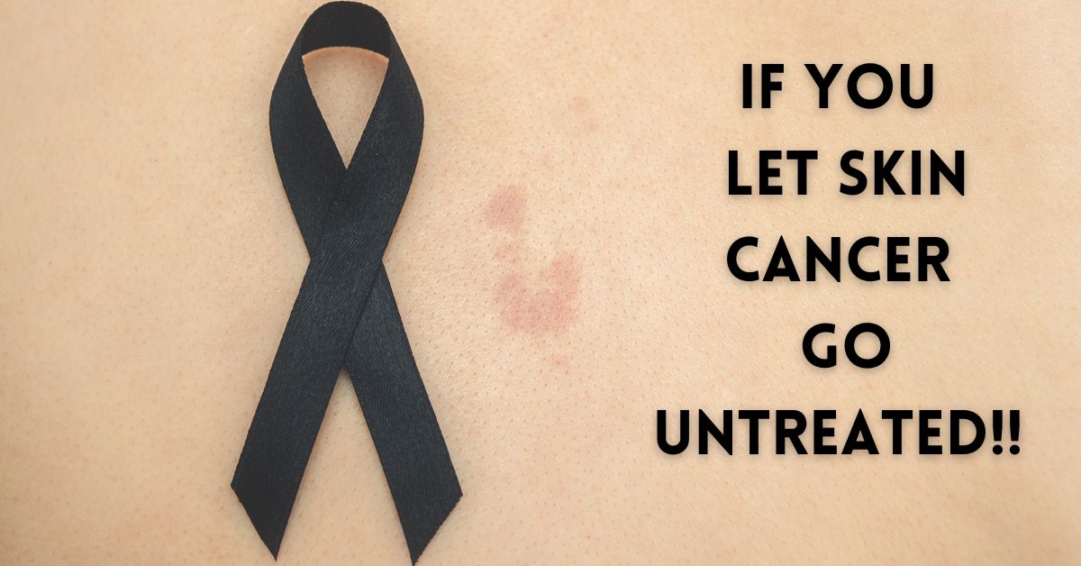 skin cancer go untreated 