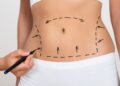 Best Fat Reduction Treatments to Sculpt Your Dream Body!