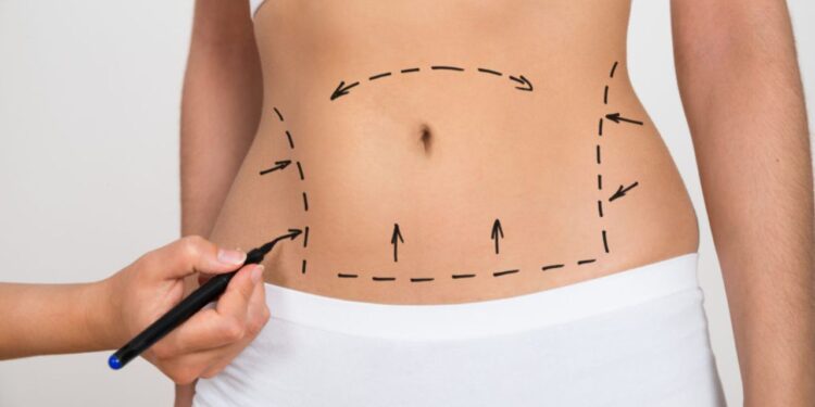 Best Fat Reduction Treatments to Sculpt Your Dream Body!