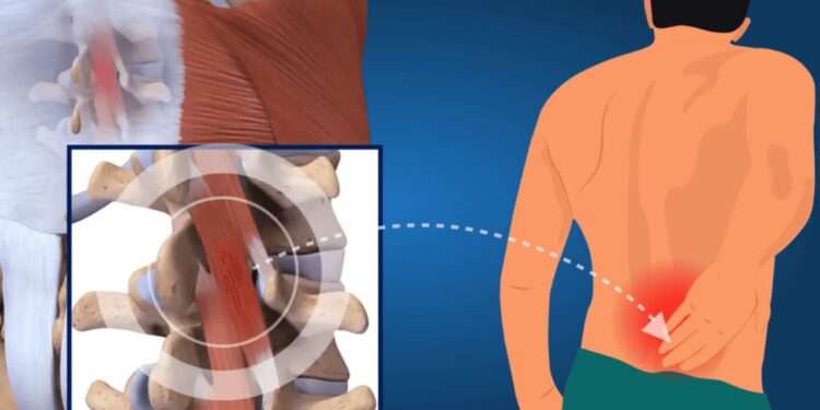 What Is Lower Back Pain and Why Does It Matter